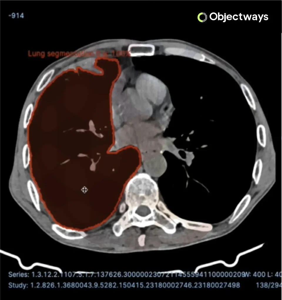 CT scan of a human chest showing AI-powered lung segmentation, with the right lung accurately highlighted in red