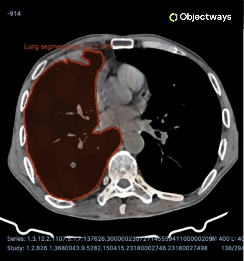 CT scan of a human chest showing AI-powered lung segmentation, with the right lung accurately highlighted in red