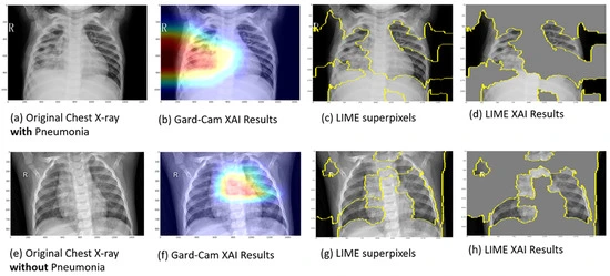 Comparison of XAI techniques like Grad-CAM and LIME on chest X-rays to visualize and explain AI diagnoses of pneumonia