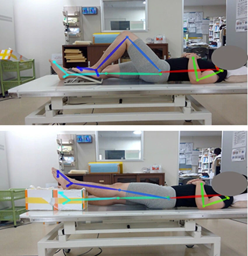 Using pose estimation in physical therapy to track a patient's leg movements and measure joint angles during rehabilitation